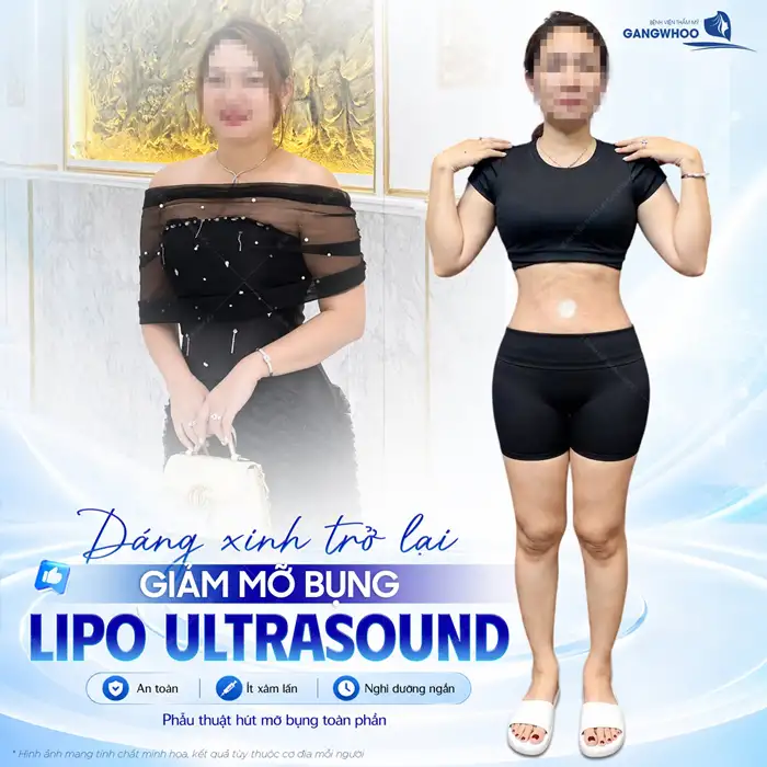 Hút Mỡ Bụng Không Xâm Lấn Phương Pháp Làm Đẹp An Toàn