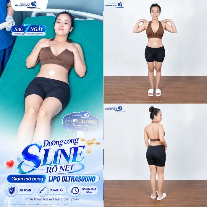 Hút Mỡ Bụng Ở Đâu An Toàn Không Lo Xảy Ra Biến Chứng Nguy Hiểm