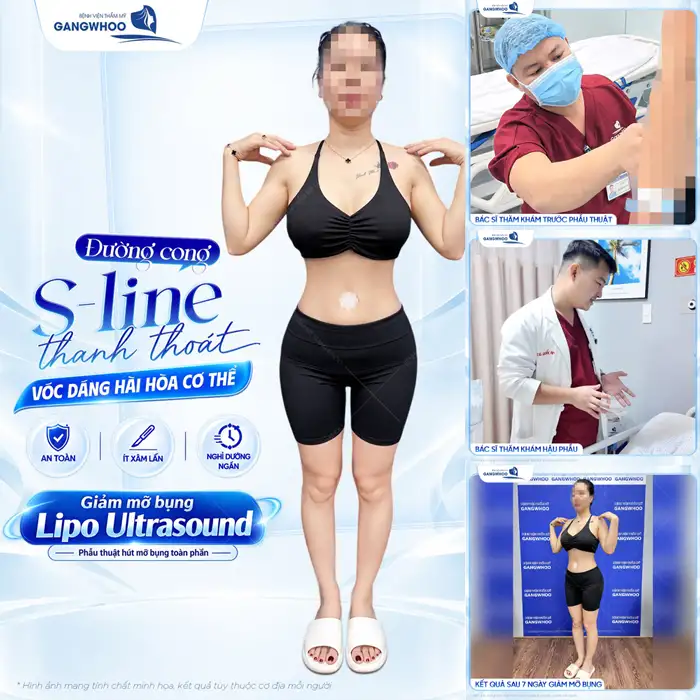 Hút Mỡ Bụng Không Xâm Lấn Phương Pháp Làm Đẹp An Toàn