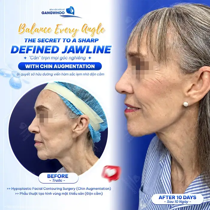 Độn cằm – Xu hướng làm đẹp cho khuôn mặt chuẩn V-Line