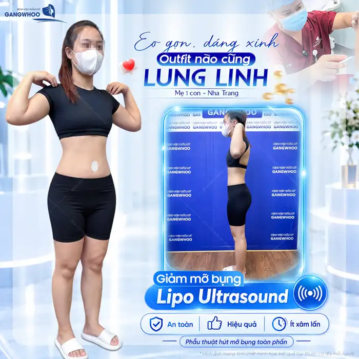 Công Nghệ Hút Mỡ Bụng Chuẩn Hàn Thoát Vòng Eo “Bánh Mì”