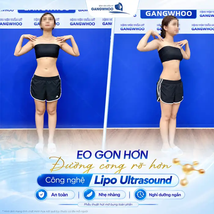 Hút Mỡ Bụng Không Xâm Lấn Phương Pháp Làm Đẹp An Toàn