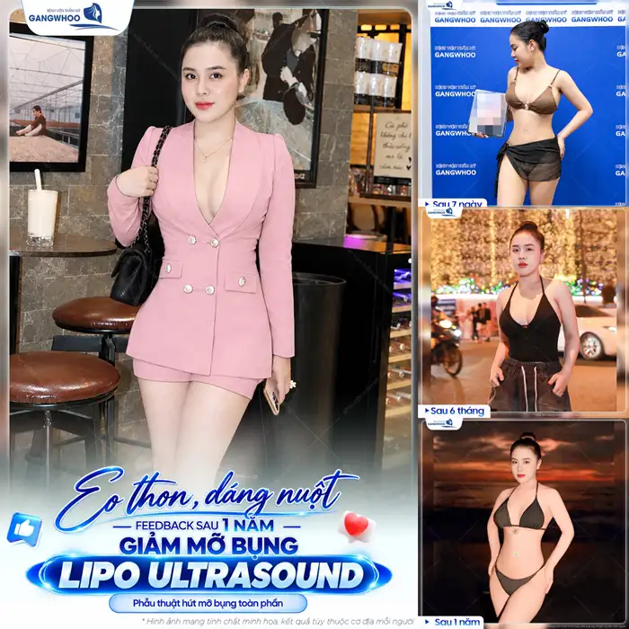 Công Nghệ Hút Mỡ Bụng Chuẩn Hàn Thoát Vòng Eo “Bánh Mì”