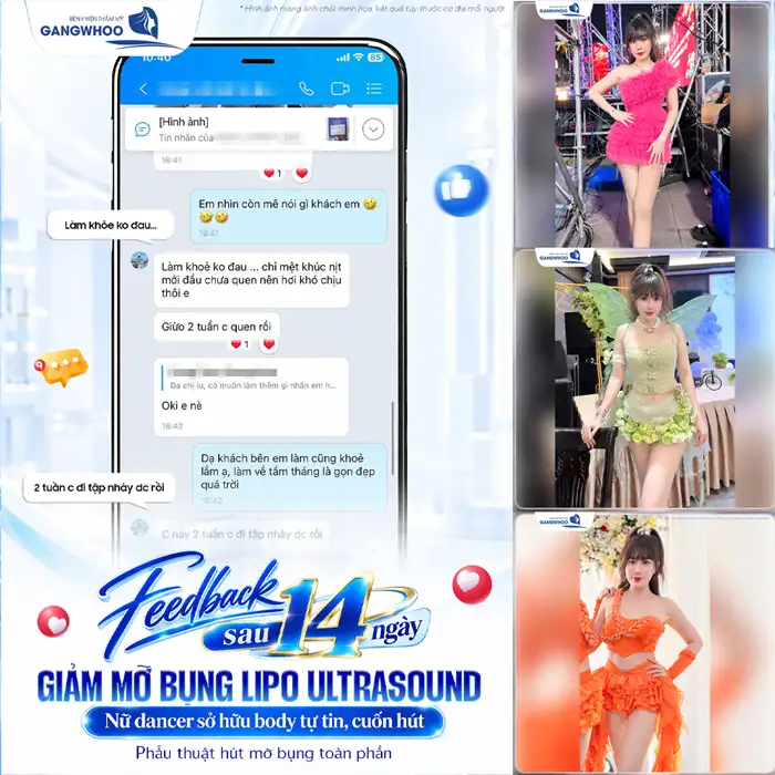 Hút Mỡ Bụng Trên Sở Hữu Vòng Eo Thon Không Còn Là Chuyện Khó