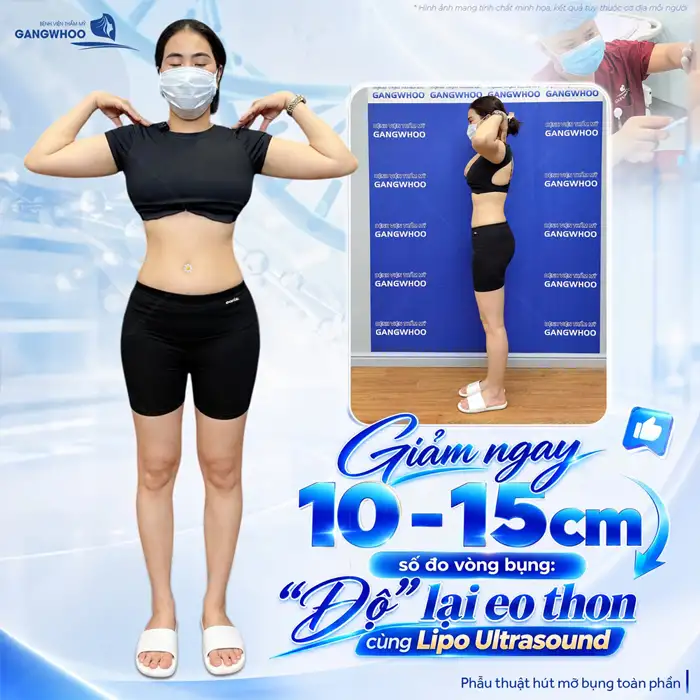 Hút Mỡ Bụng Ở Đâu An Toàn Không Lo Xảy Ra Biến Chứng Nguy Hiểm