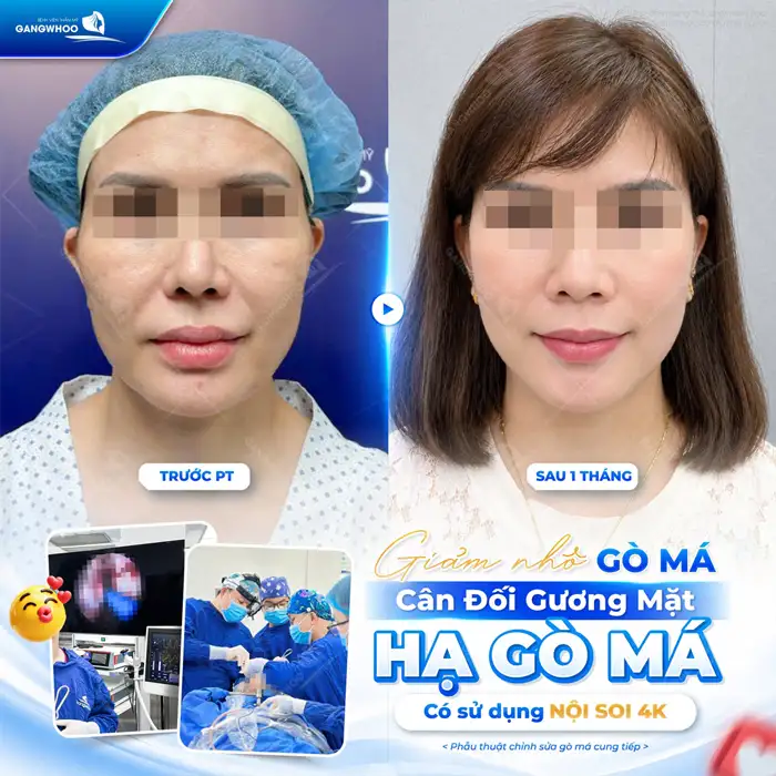 Hạ gò má và thông tin quan trọng không nên bỏ lỡ