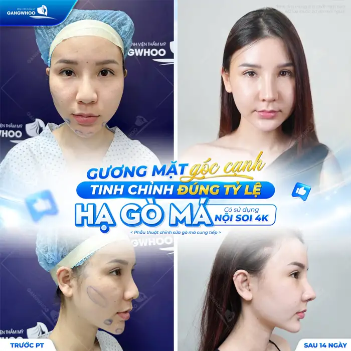Hạ gò má và thông tin quan trọng không nên bỏ lỡ