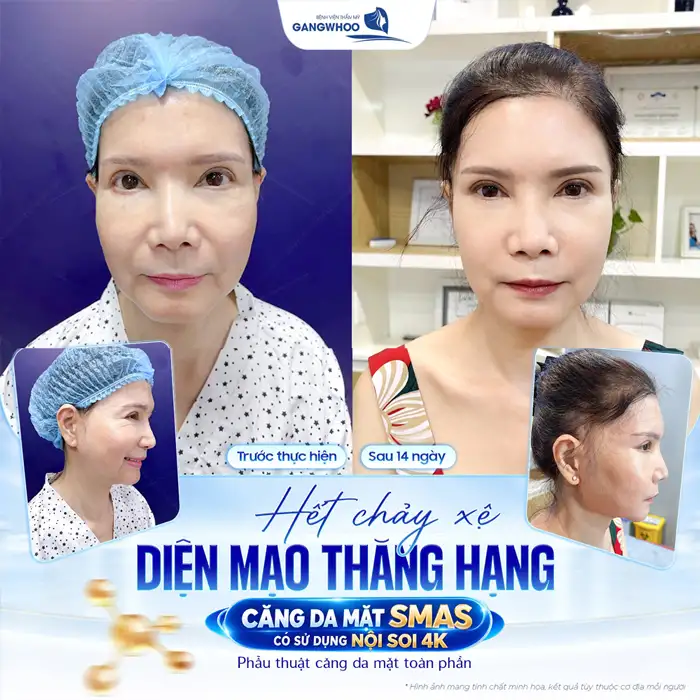 Căng da mặt – Phương pháp làm đẹp giúp trẻ hóa làn da