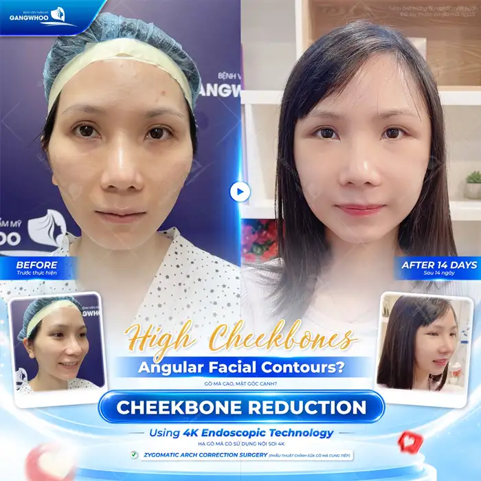 Hạ gò má và thông tin quan trọng không nên bỏ lỡ