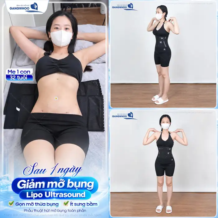 Liệu Bạn Đã Biết Hút Mỡ Bụng Ở Đâu An Toàn Tại TPHCM Chưa?