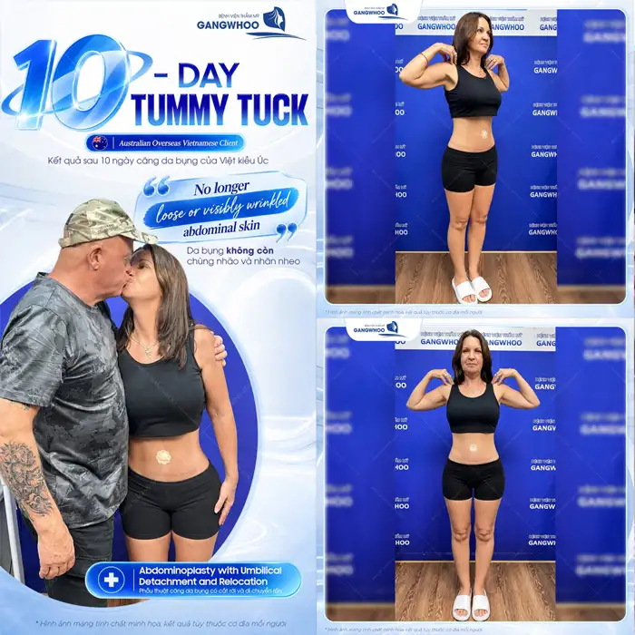 Hút mỡ bụng phẫu thuật thẩm mỹ giúp bụng, eo thon dáng đẹp