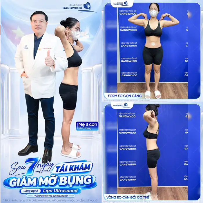 Hút mỡ bụng phẫu thuật thẩm mỹ giúp bụng, eo thon dáng đẹp