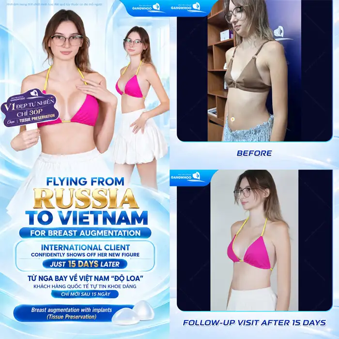 Nâng ngực đường nào tốt hiện nay?