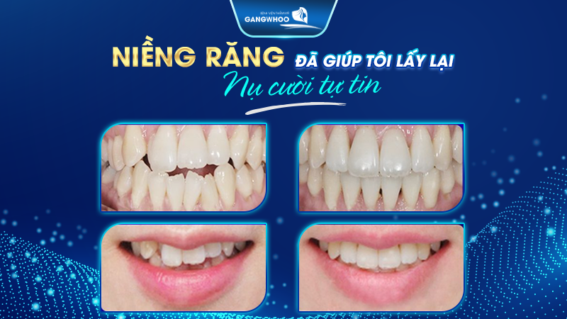 Niềng răng tại bệnh viện Gangwhoo