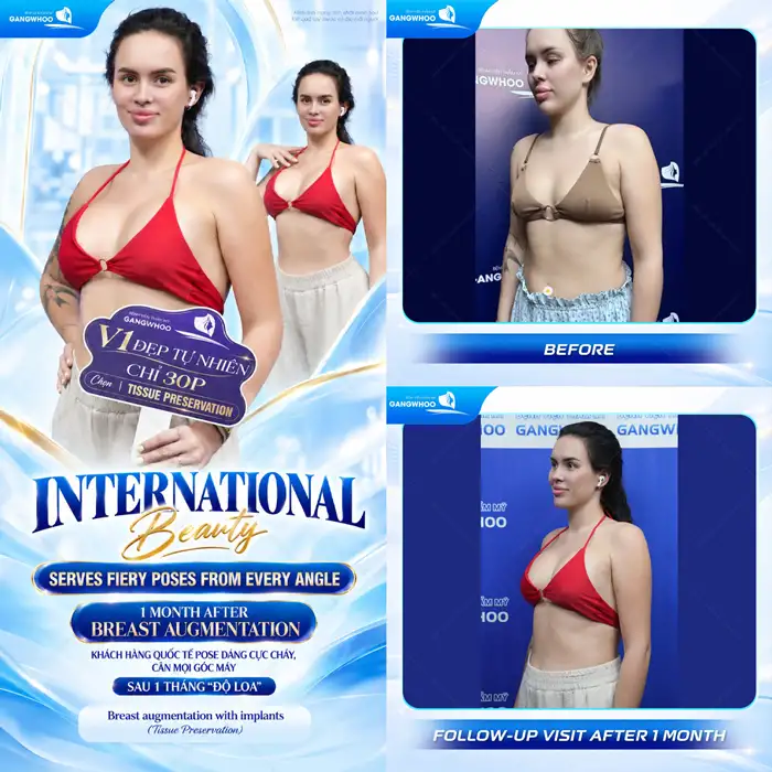 Nâng Ngực Sau Bao Lâu Thì Mềm Và Đẹp Tự Nhiên