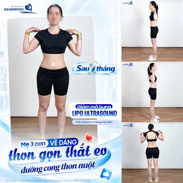 Tuân Thủ Quy Trình Hút Mỡ Bụng Sở Hữu Eo Thon Trong Tích Tắc
