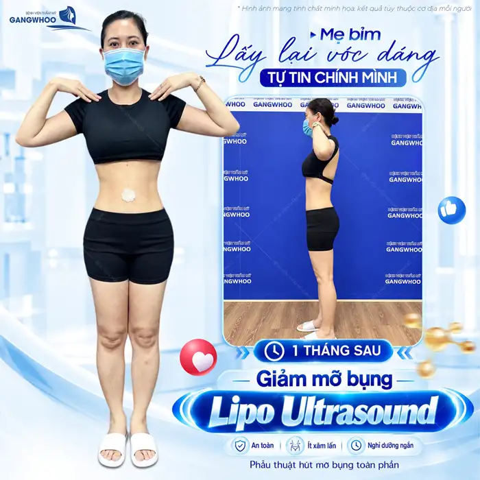 Hút Mỡ Bụng Không Xâm Lấn Phương Pháp Làm Đẹp An Toàn