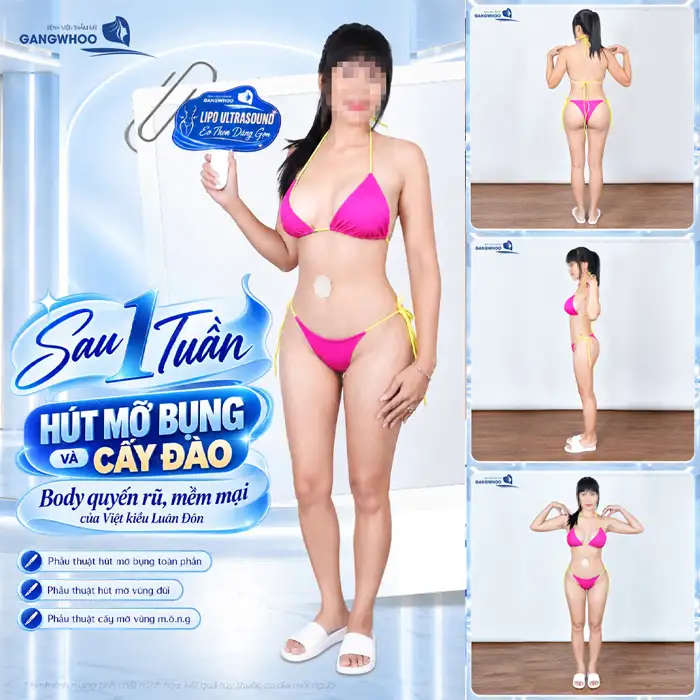 Tuân Thủ Quy Trình Hút Mỡ Bụng Sở Hữu Eo Thon Trong Tích Tắc