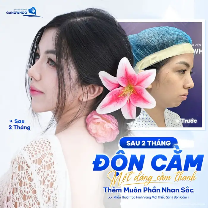 Độn cằm – Xu hướng làm đẹp cho khuôn mặt chuẩn V-Line