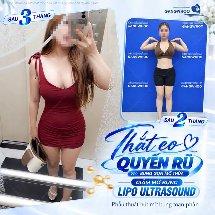 Tuân Thủ Quy Trình Hút Mỡ Bụng Sở Hữu Eo Thon Trong Tích Tắc