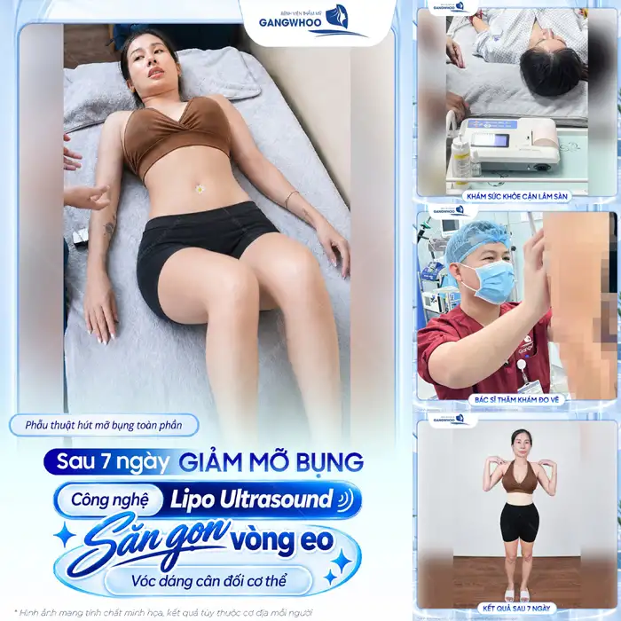 Hút mỡ bụng phẫu thuật thẩm mỹ giúp bụng, eo thon dáng đẹp