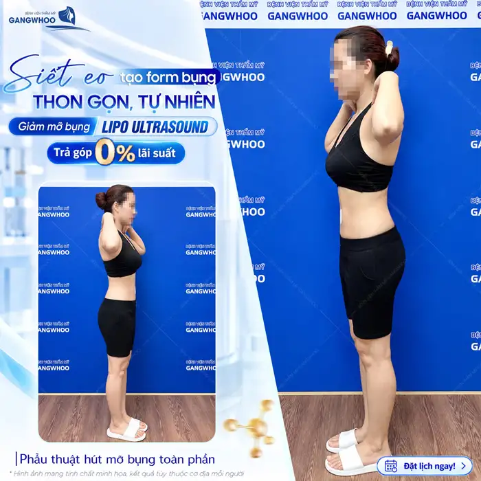 Hút Mỡ Bụng Không Xâm Lấn Phương Pháp Làm Đẹp An Toàn
