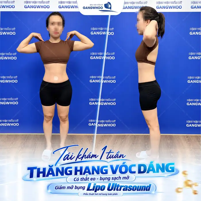 Hút Mỡ Bụng Không Xâm Lấn Phương Pháp Làm Đẹp An Toàn