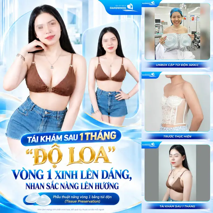 Nâng Ngực Sau Bao Lâu Thì Mềm Và Đẹp Tự Nhiên