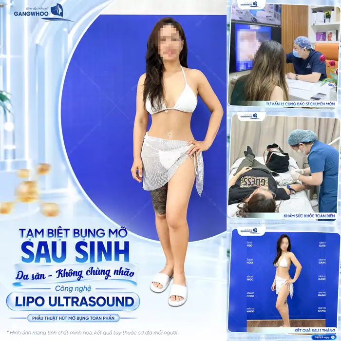 Công Nghệ Hút Mỡ Bụng Chuẩn Hàn Thoát Vòng Eo “Bánh Mì”