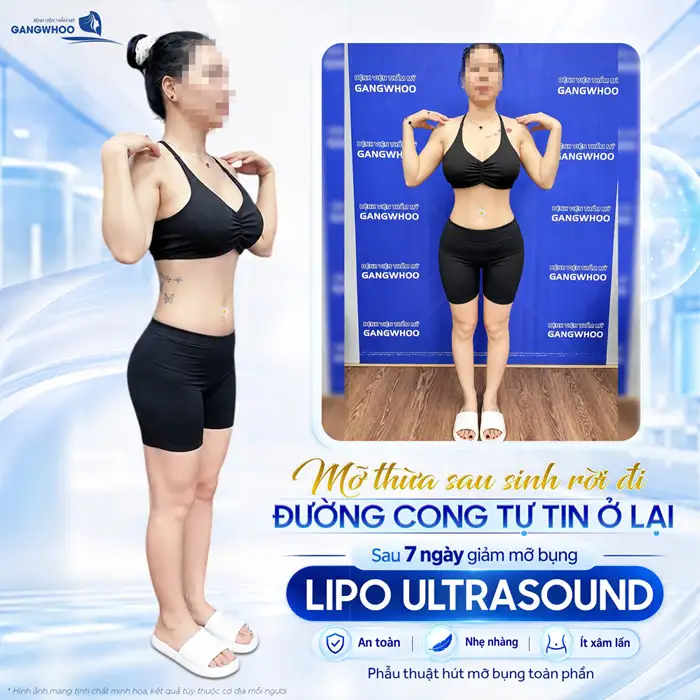 Liệu Bạn Đã Biết Hút Mỡ Bụng Ở Đâu An Toàn Tại TPHCM Chưa?
