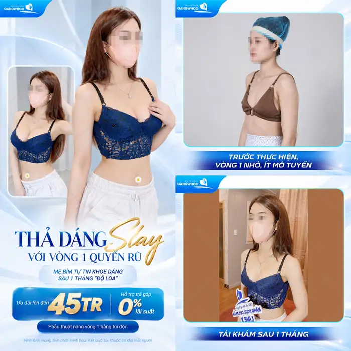 Nâng ngực giá bao nhiêu? Cập nhật bảng giá tại GANGWHOO