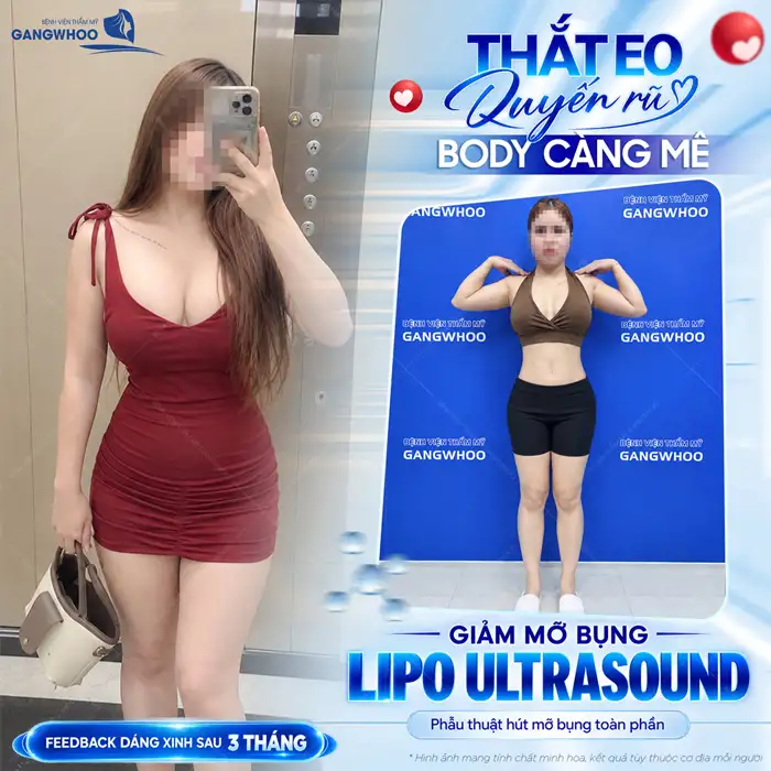 Liệu Bạn Đã Biết Hút Mỡ Bụng Ở Đâu An Toàn Tại TPHCM Chưa?