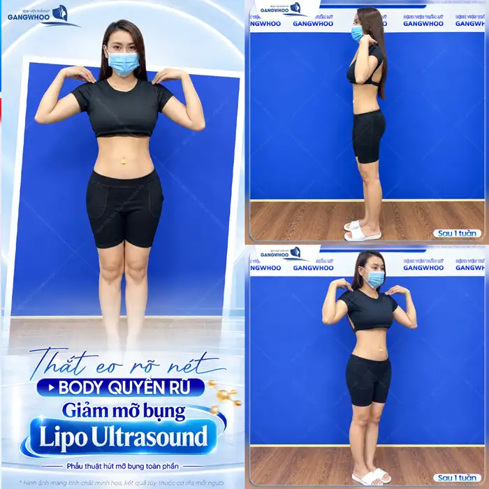 Hút mỡ bụng phẫu thuật thẩm mỹ giúp bụng, eo thon dáng đẹp