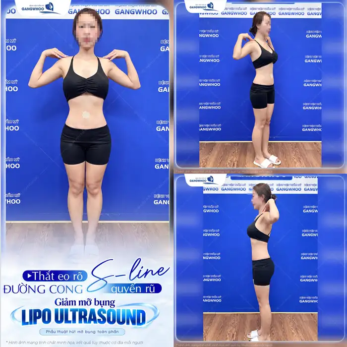 Hút mỡ bụng phẫu thuật thẩm mỹ giúp bụng, eo thon dáng đẹp