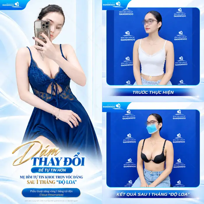 Nâng ngực đường quầng và những điều cần lưu ý