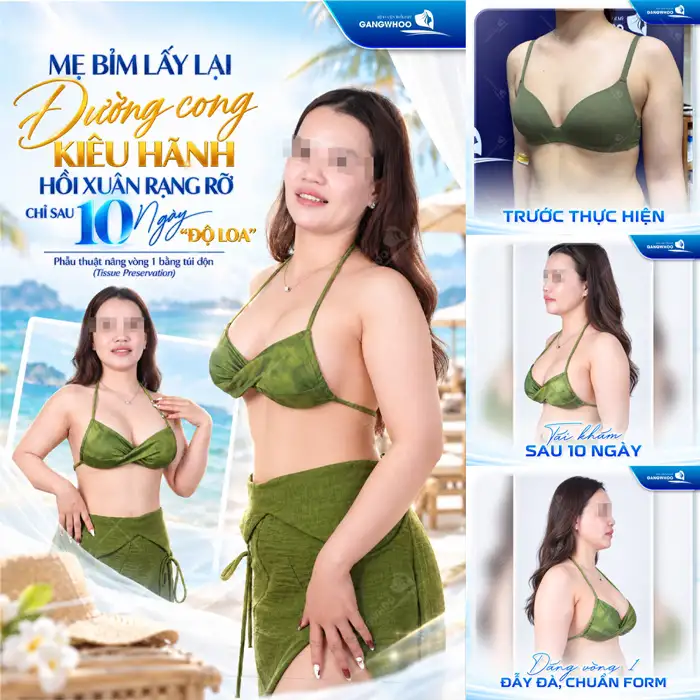 Nâng ngực đường quầng và những điều cần lưu ý