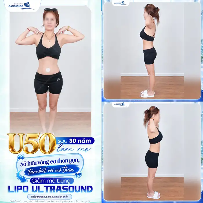Liệu Bạn Đã Biết Hút Mỡ Bụng Ở Đâu An Toàn Tại TPHCM Chưa?