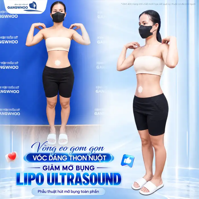 Hút mỡ bụng phẫu thuật thẩm mỹ giúp bụng, eo thon dáng đẹp