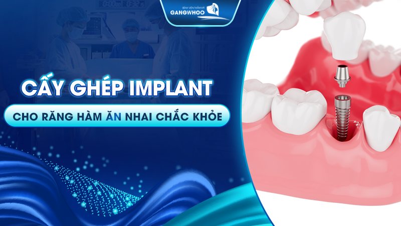 cấy ghép implant cho răng hàm ăn nhai chắc khỏe