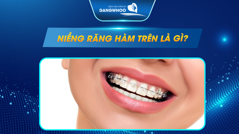 Niềng răng hàm trên là gì