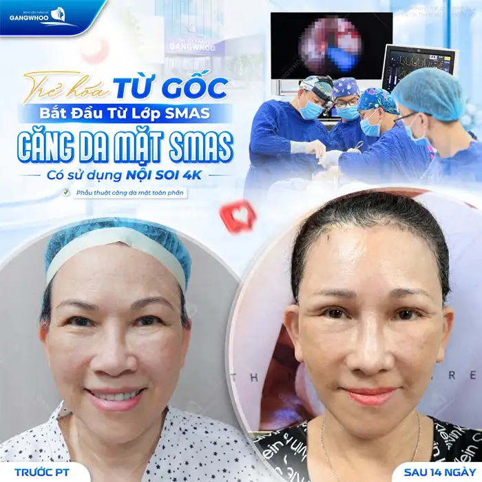 Căng Da Mặt Có Hại Không? Điều Cần Lưu Ý Để Căng Da Mặt An Toàn