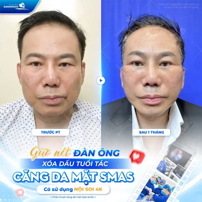 Căng Da Mặt Bao Lâu Thì Lành? Cách Chăm Sóc Da Mặt Hồi Phục Nhanh Hơn