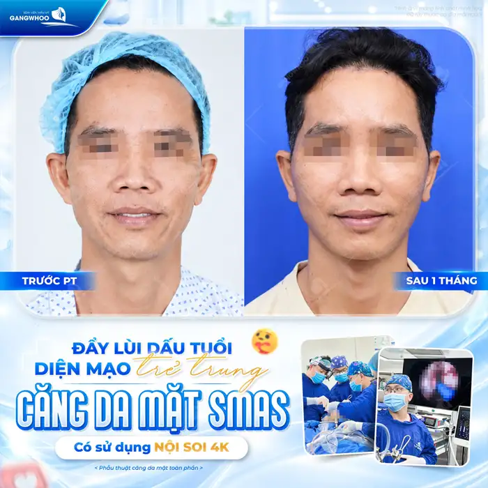 Bao Nhiêu Tuổi Thì Nên Căng Da Mặt Là Đẹp -?