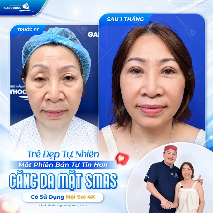 Tiểu Phẫu Căng Da Mặt Sở Hữu Làn Da Căng Mịn