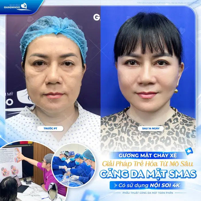 Những Phương Pháp Căng Da Mặt Nào Hiệu Quả – Hiện Nay?