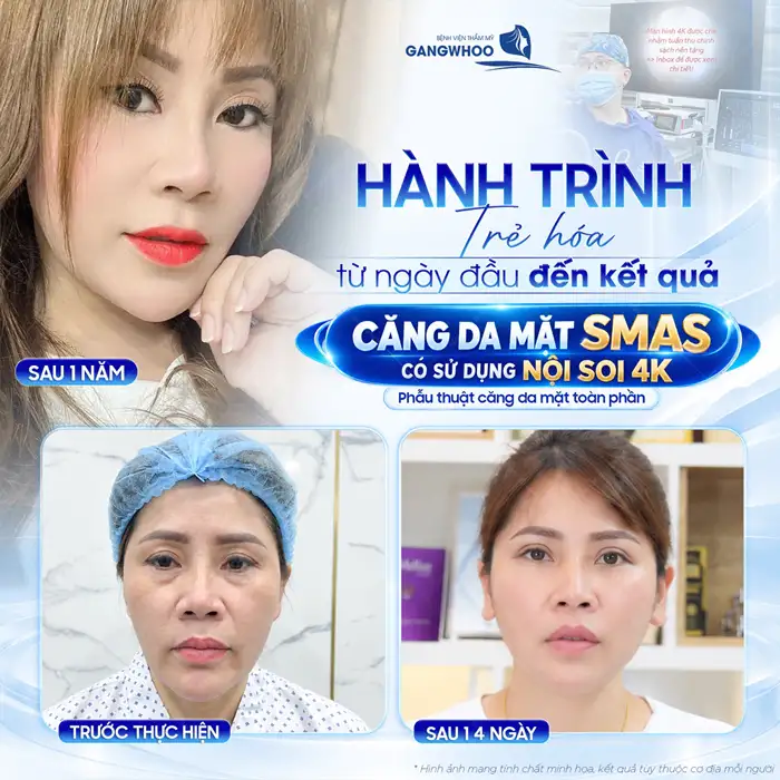 4 Tiêu Chí Để Lựa Chọn Địa Điểm Căng Da Mặt Ở Đâu tốt