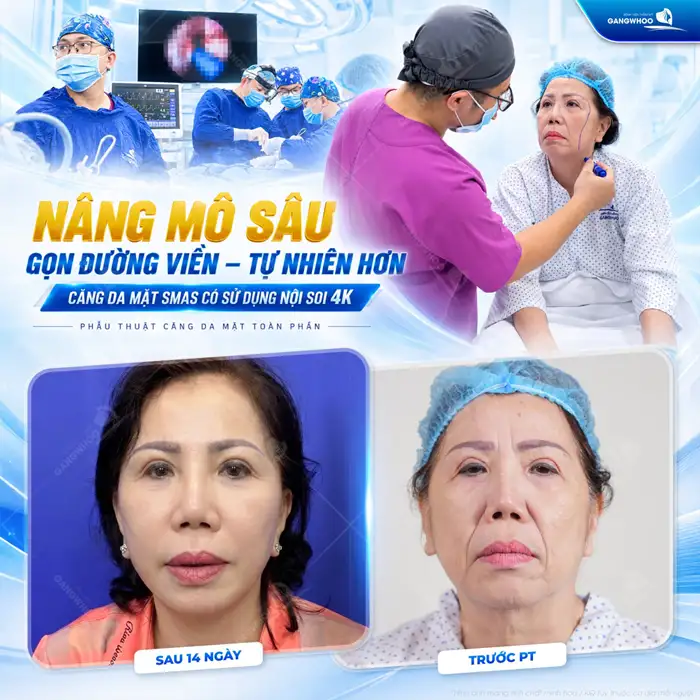 Căng Da Mặt Có Hại Không? Điều Cần Lưu Ý Để Căng Da Mặt An Toàn