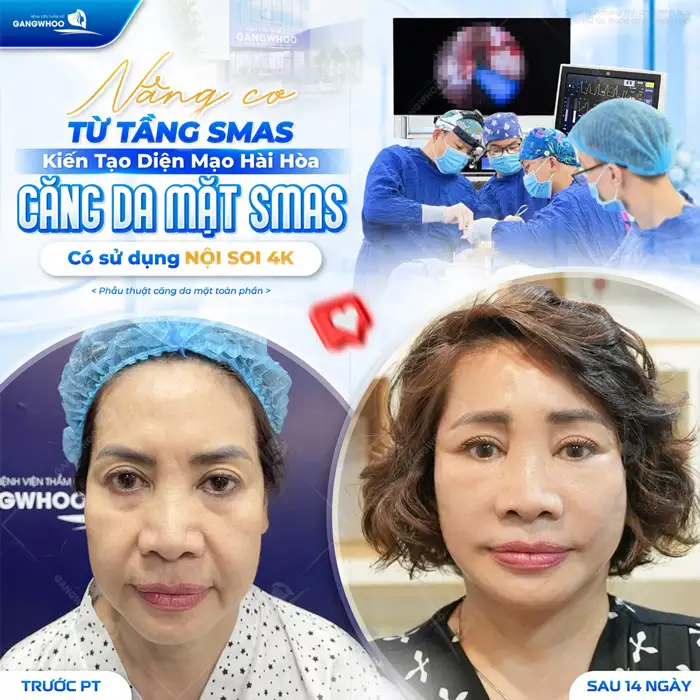 Những Phương Pháp Căng Da Mặt Nào Hiệu Quả – Hiện Nay?