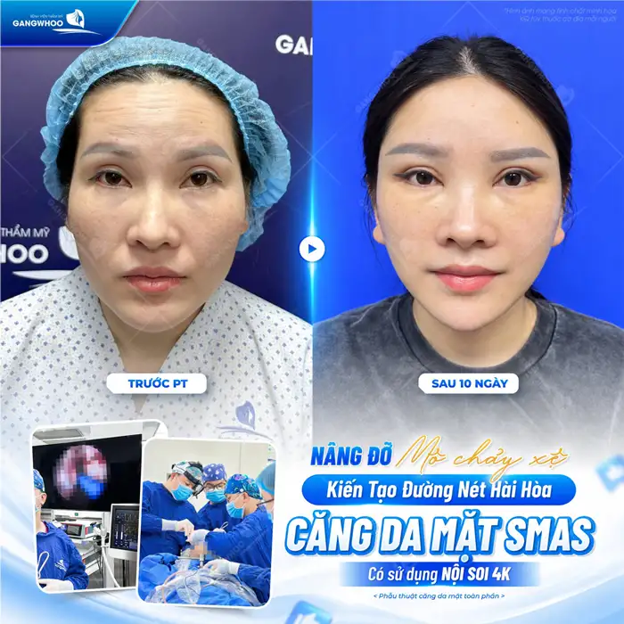 Những Phương Pháp Căng Da Mặt Nào Hiệu Quả – Hiện Nay?