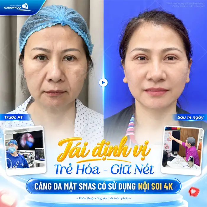 Liệu Trình Căng Da Mặt Hiệu Quả Như Thế Nào, Bạn Đã Biết Chưa?